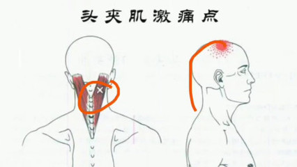 脑仁疼是怎么回事