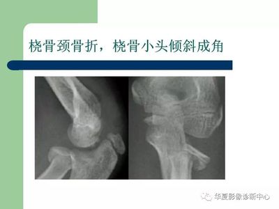 骨颈骨折后几个月能好