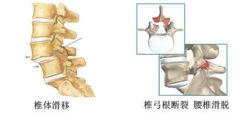 腰5椎弓峡部裂怎么治疗
