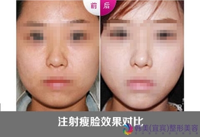 botox注射瘦脸效果