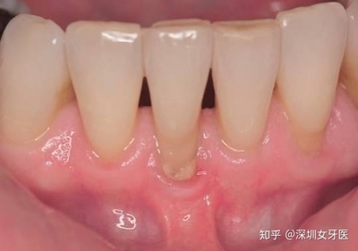 牙缝大怎么治疗