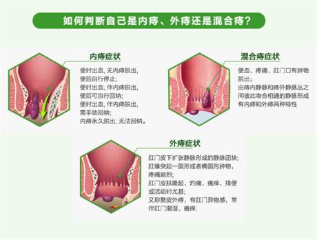 内痔外痔怎么治疗
