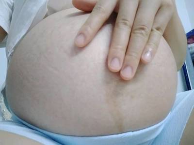 怀孕没有妊娠纹