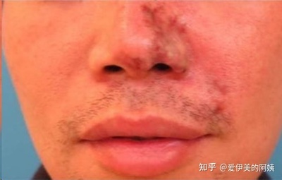 男生隆鼻要多少钱