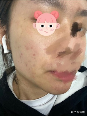 脸上老是长很痛的痘痘
