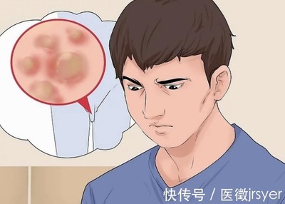 尖锐怎么治疗