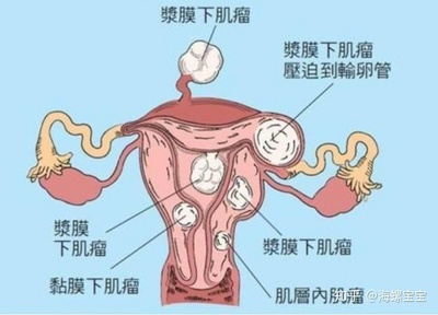 宫颈肿瘤怎么治疗