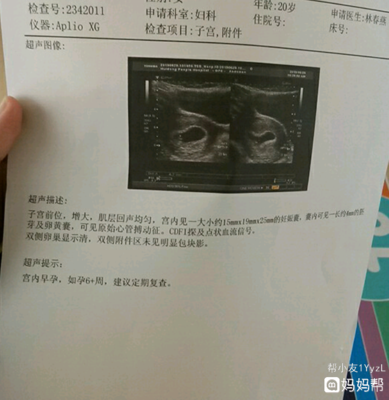 双侧卵巢多囊会怀孕吗