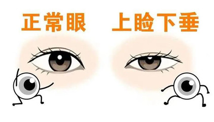 小儿眼睑下垂怎么治疗