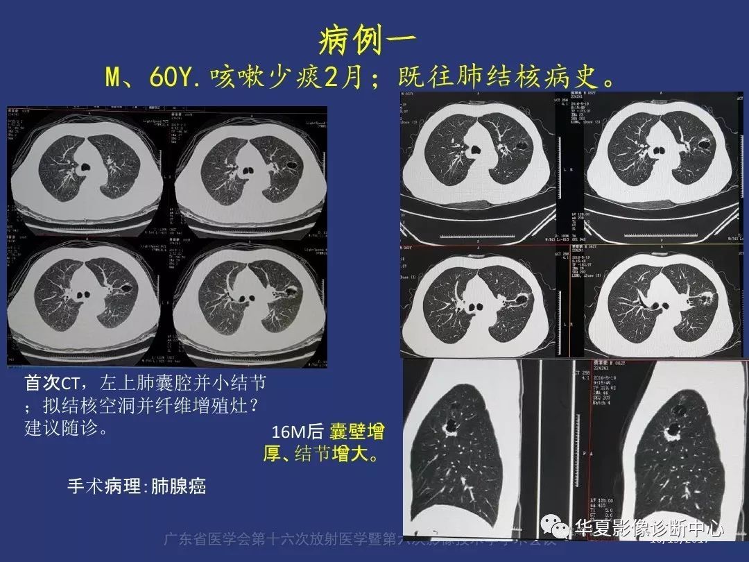 肺小结节会引起咳嗽吗