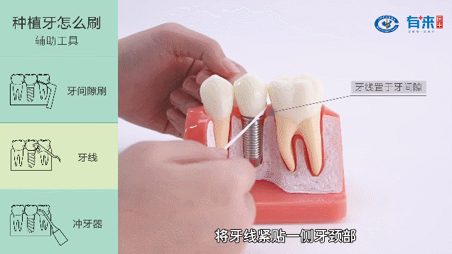 种牙齿后怎么