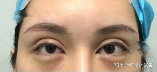 下眼皮凹陷修复哪里好