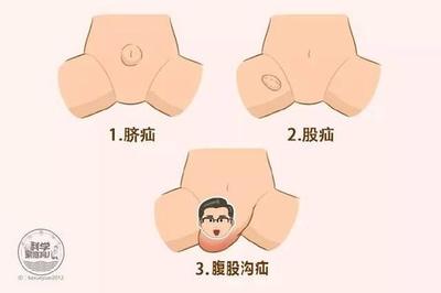 小孩疝气是怎么回事