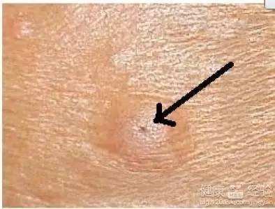 粉瘤和痘痘的区别