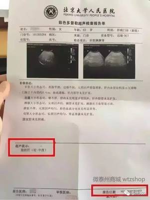 查脂肪肝做b超多少钱