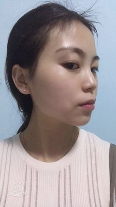 瘦脸针几天有感觉