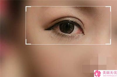 做双眼皮微创