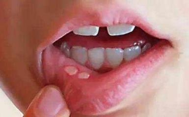 口腔溃疡能吃豆腐吗