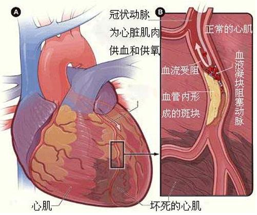 心机缺血是怎么回事