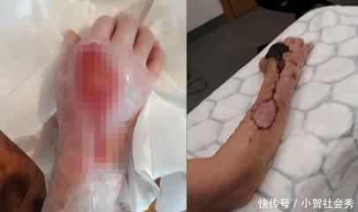 伤口发黑是怎么回事