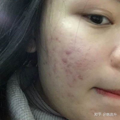 痘痘肌可以用茶叶敷脸吗