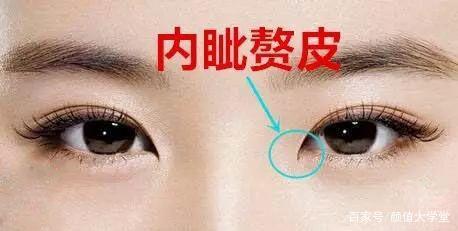 内眦赘皮双眼皮
