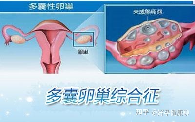 卵泡多怎么治疗