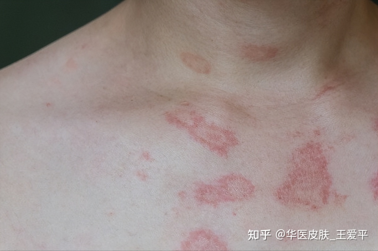 治 玫瑰糠疹大概要多少