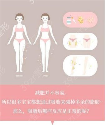 减肥全身抽脂价格