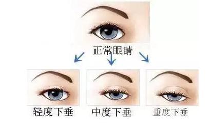 贴双眼皮贴