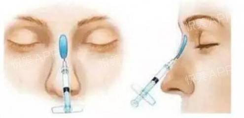 注射隆鼻术有哪些注意事项