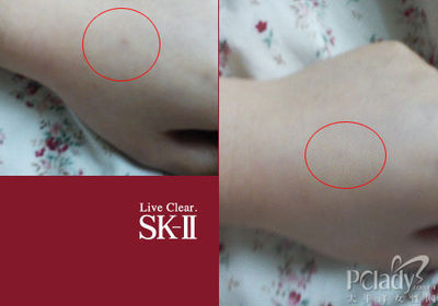 sk2用了长痘痘