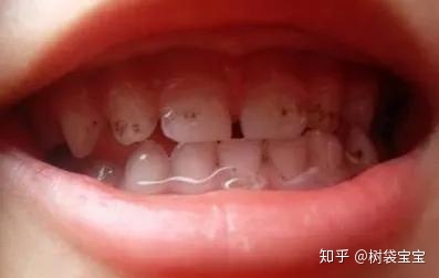 牙齿里面发黑是怎么回事