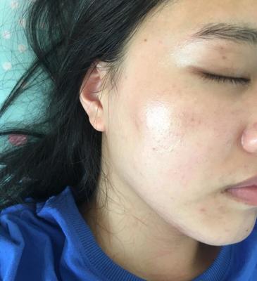 有痘痘痘印的怎么化妆