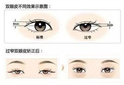 全切双眼皮和埋线哪个好