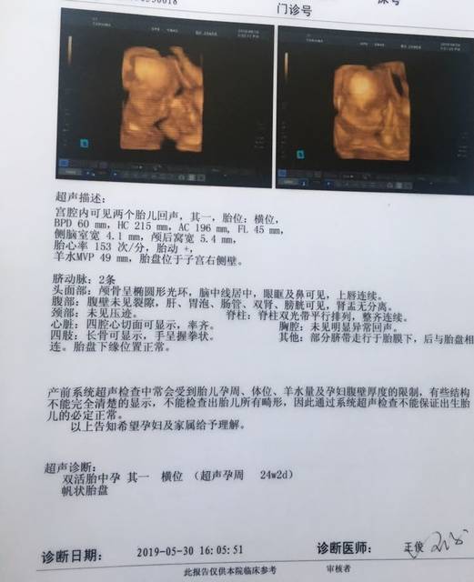 帆状胎盘的宝宝成活率