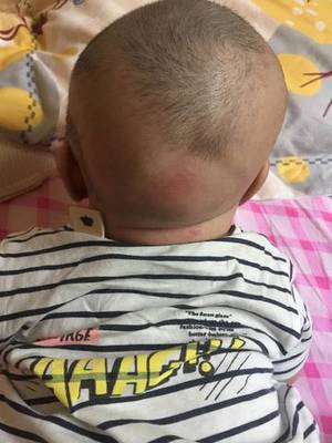 宝宝后脑勺大怎么回事
