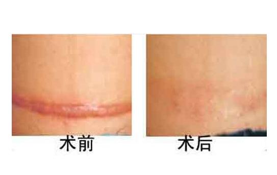 凸疤痕