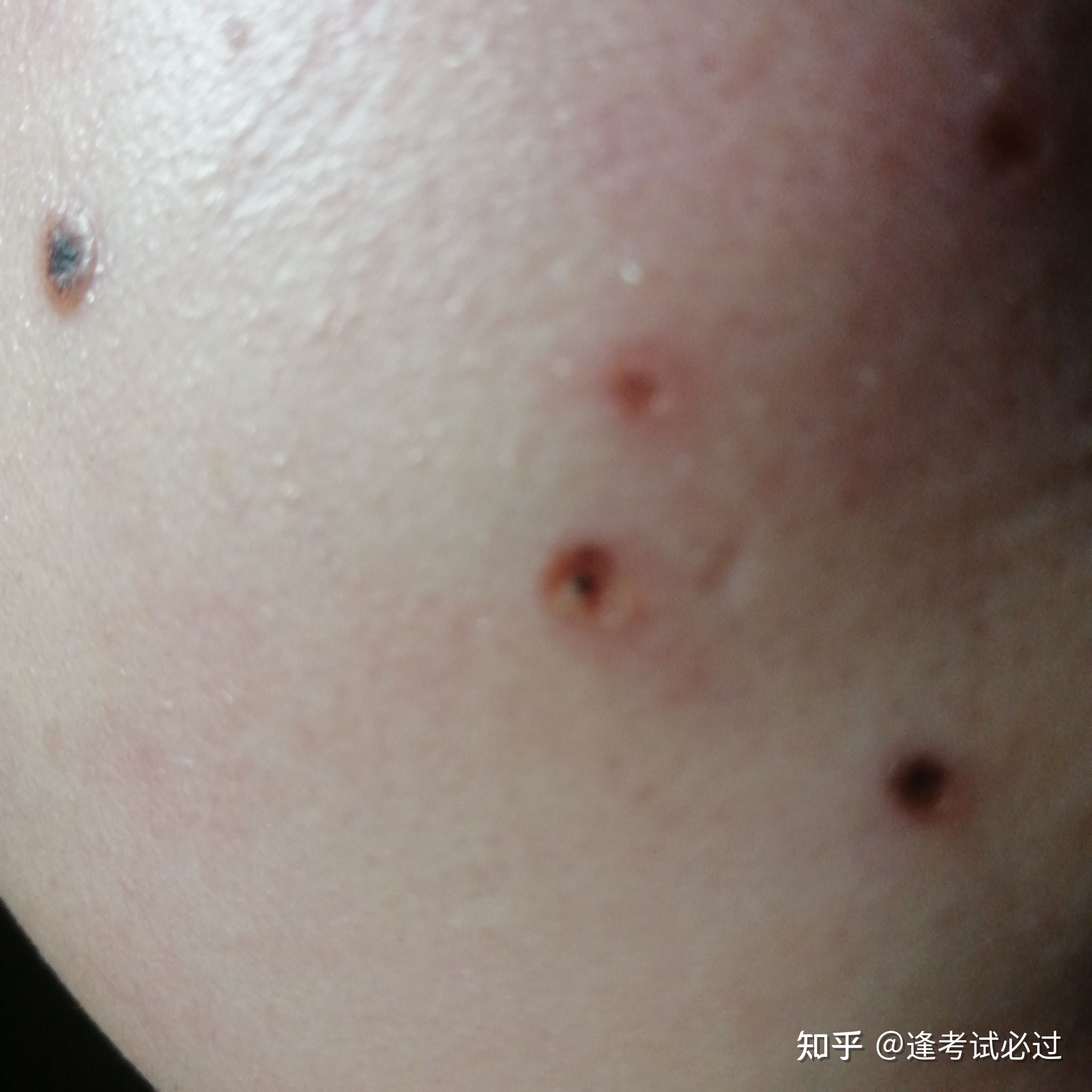 点痣几天结痂