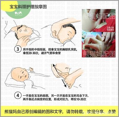 新生儿斜颈