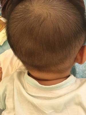 宝宝后脑勺大怎么回事