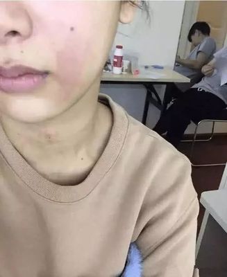荨麻疹会长脸上吗