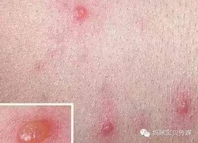 宝宝荨麻疹可以洗澡吗