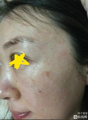 怀孕脸上过敏