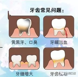 洗牙后牙龈萎缩