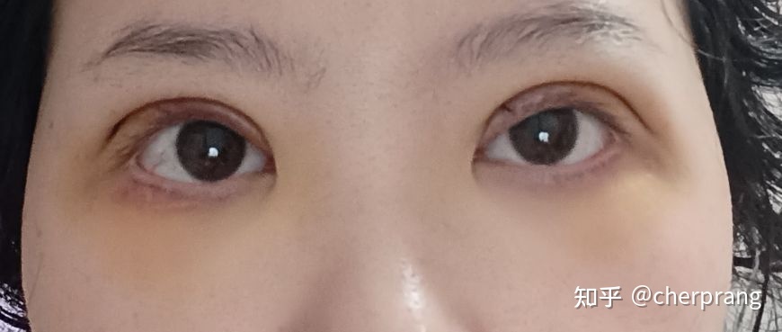 双眼皮可以自己拆线吗