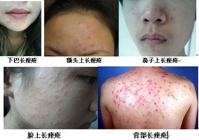 长春痘痘专注肤康