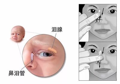 新生儿泪道堵塞的症状