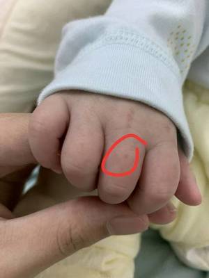 宝宝手上红色点点