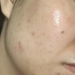水光针治痘痘有用吗
